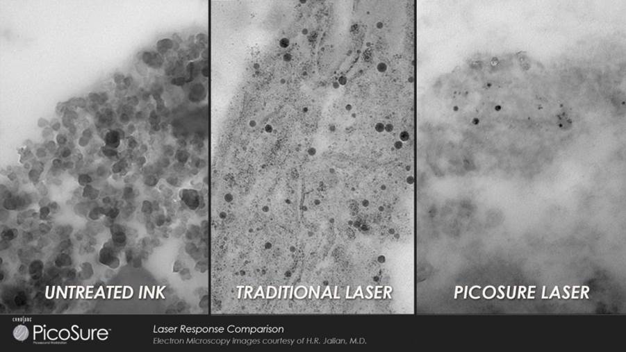 PicoSure_vs_Yag_Laser_Elektronen_Mikroskop