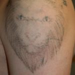Newskin - Tattooentfernung in Traun bei Linz|Vorher-/Nachherbilder