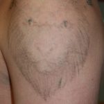 Newskin - Tattooentfernung in Traun bei Linz|Vorher-/Nachherbilder