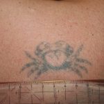 Newskin - Tattooentfernung in Traun bei Linz|Vorher-/Nachherbilder