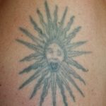 Newskin - Tattooentfernung in Traun bei Linz|Vorher-/Nachherbilder