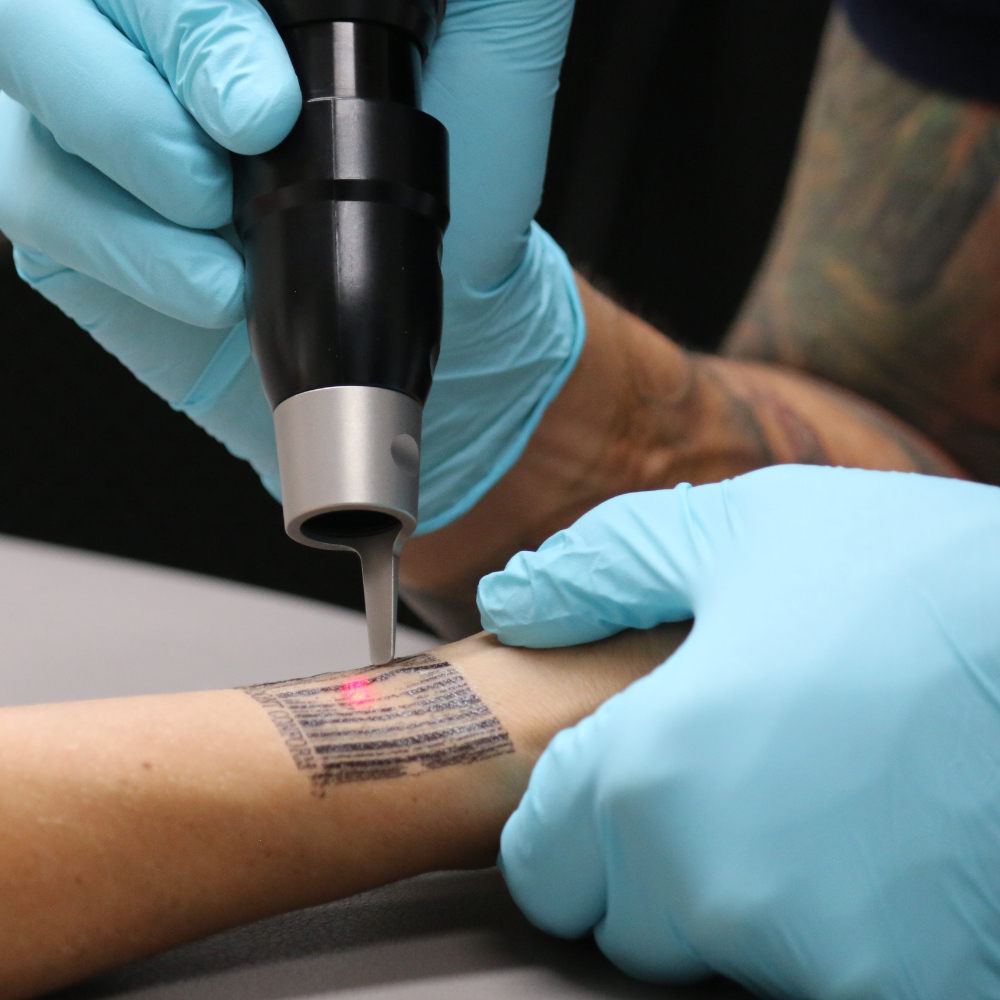 Newskin - Tattooentfernung in Traun bei Linz|Behandlungsablauf