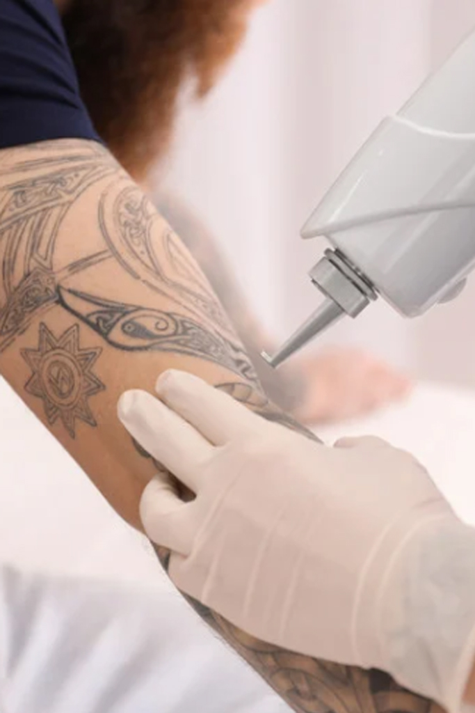 Newskin - Tattooentfernung in Traun bei Linz|Vorher-/Nachherbilder