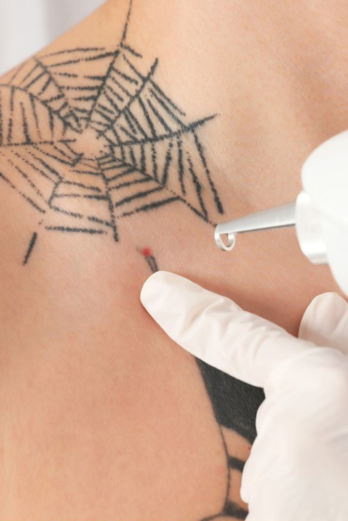 Newskin - Tattooentfernung in Traun bei Linz|Termine