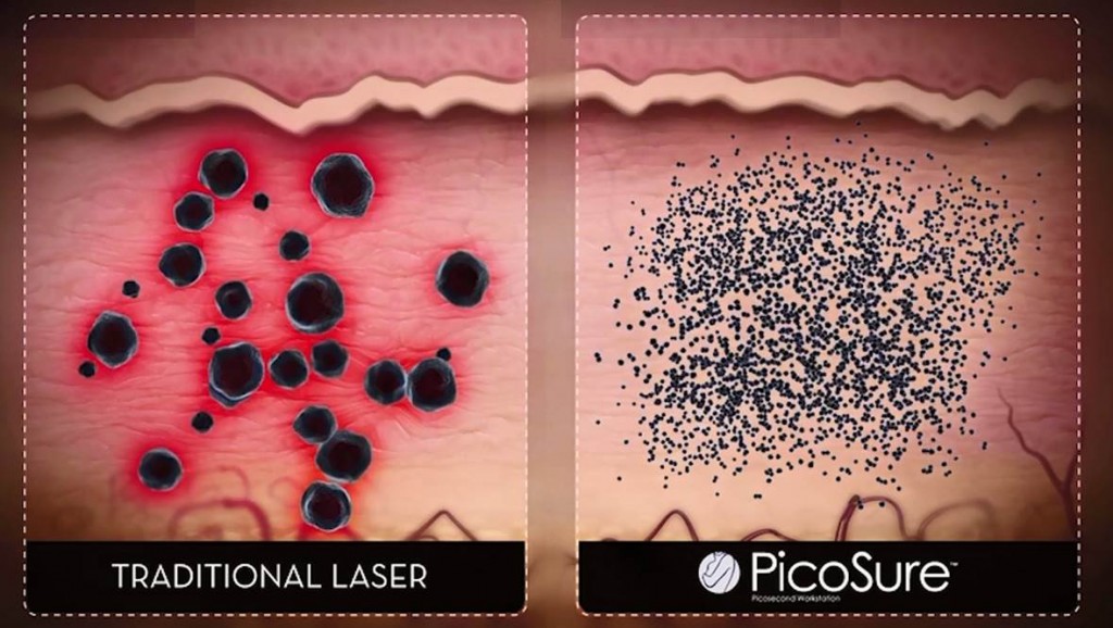 Beschreibung PicoSure PressureWave Technolgie