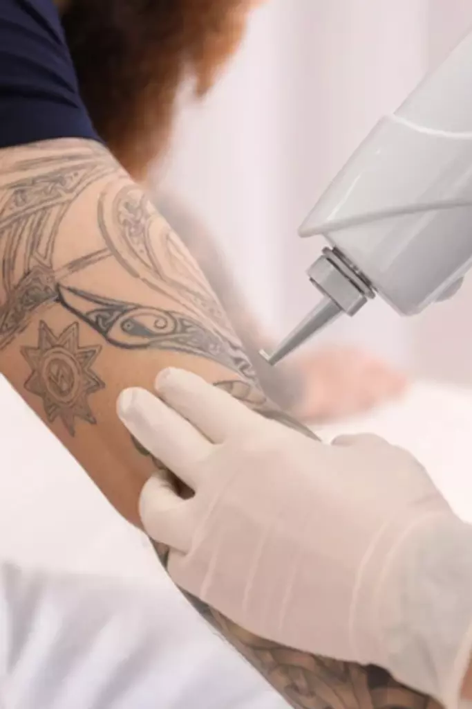 Tattooentfernung |  - Tattooentfernung