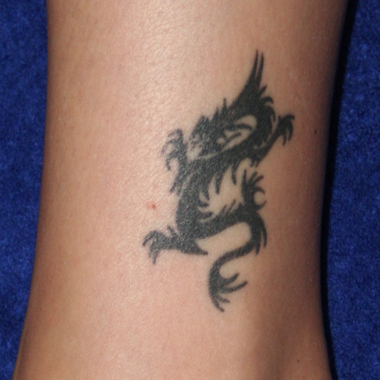 Tattooentfernung |  - Resultate