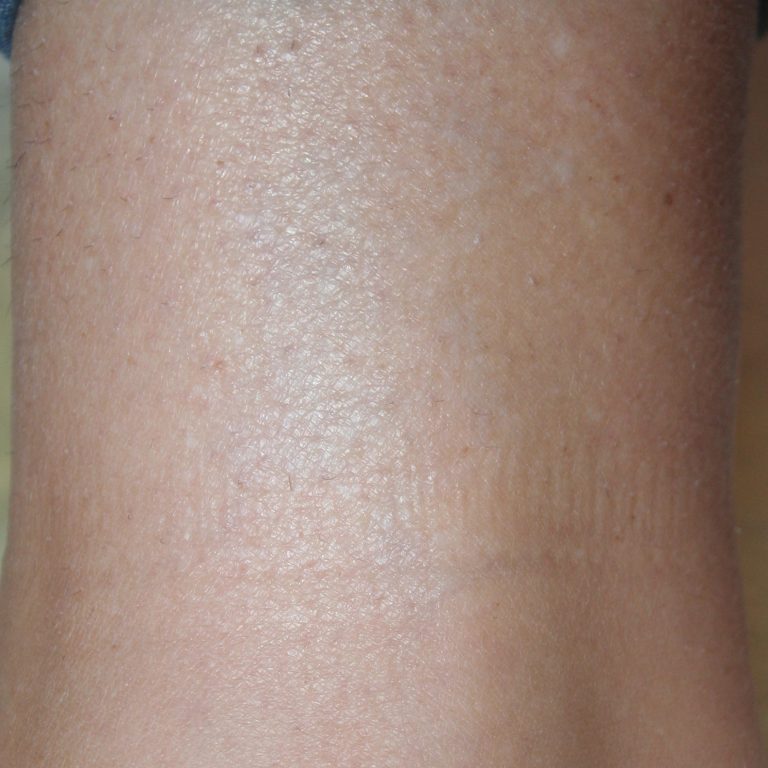 Tattooentfernung |  - Resultate