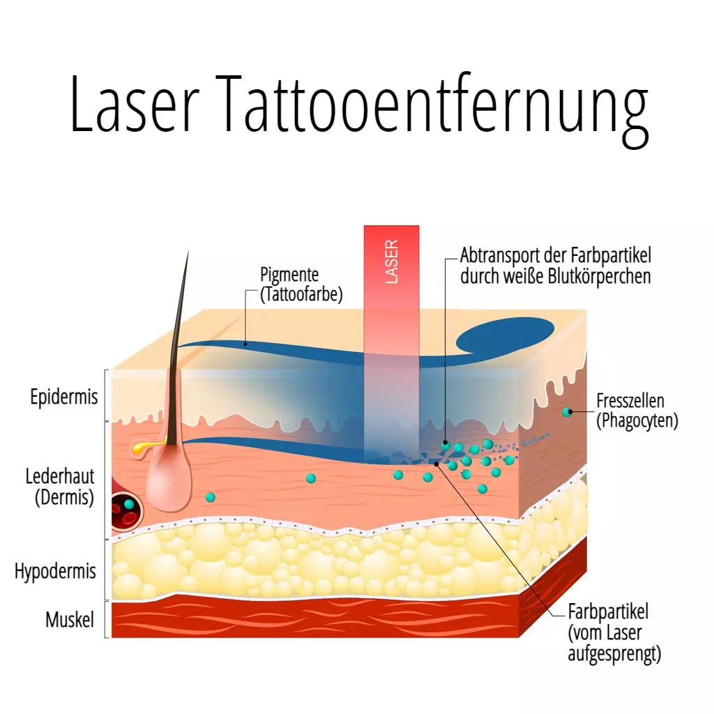 Tattooentfernung |  - FAQ’s