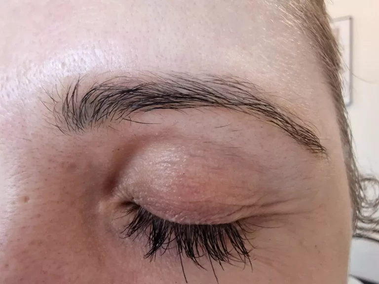 Tattooentfernung |  - Resultate