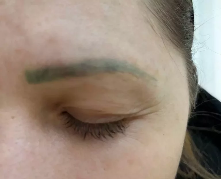 Tattooentfernung |  - Resultate